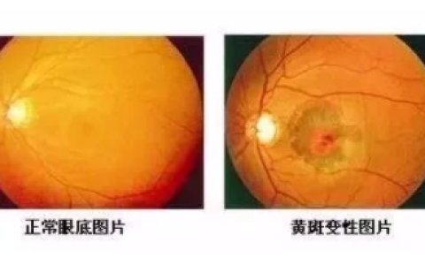 三类人群要警惕眼底黄斑病变:50岁以上的人群患病几率较大