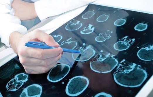 脑瘤的“祸根”是什么？细胞网状细胞瘤具有一定的遗传性